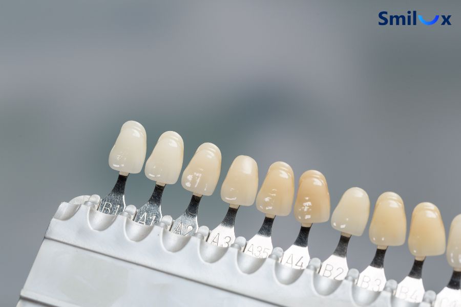Dán sứ răng thưa giúp bảo tồn mô răng thật