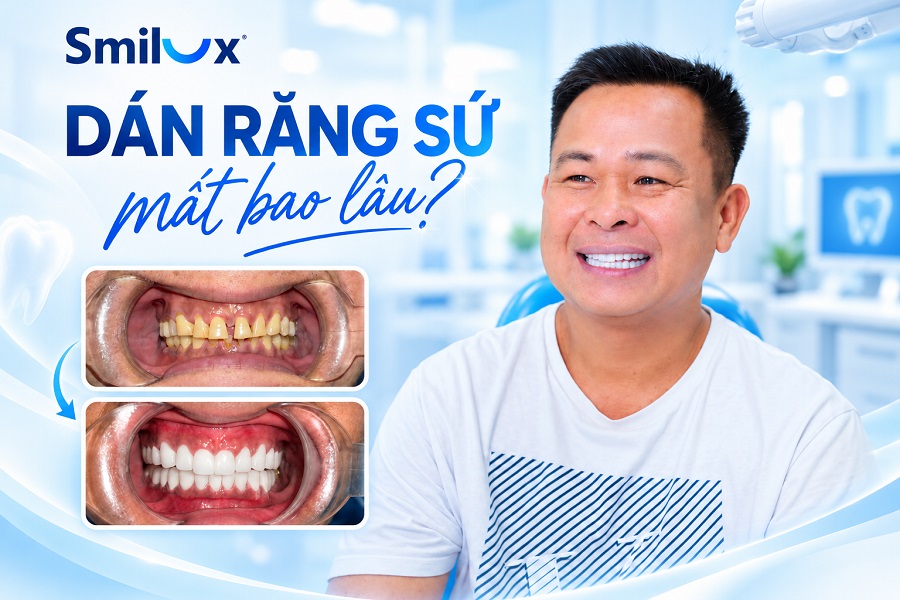 Dán răng sứ mất bao lâu? Tổng thời gian thực hiện chi tiết