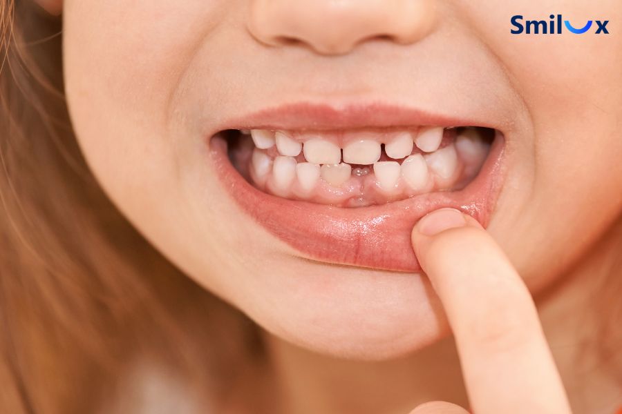 Dán sứ răng thưa phù hợp với tình trạng răng thưa ít