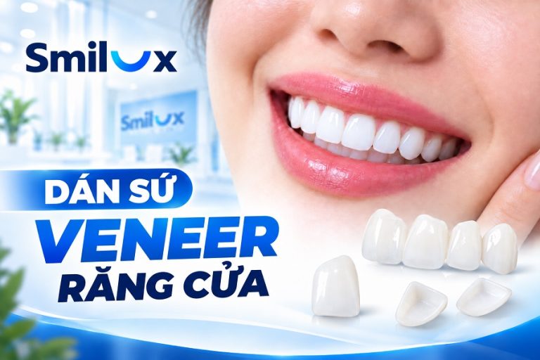 Dán sứ Veneer răng cửa có tốt không? Giá bao nhiêu tiền?