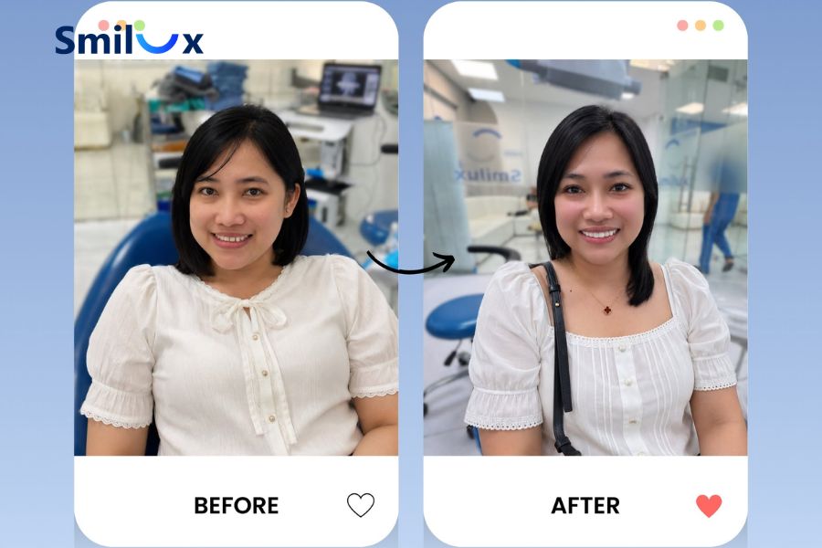 Hình ảnh khách hàng thực hiện bắc cầu răng sứ tại Smilux
