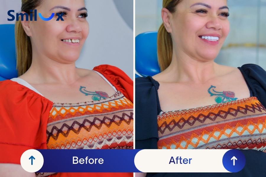 Điều kiện làm răng sứ trả góp tại Smilux đơn giản, thủ tục nhanh chóng
