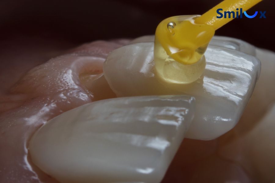 Keo dán sứ có ảnh hưởng đến độ bền của răng sứ