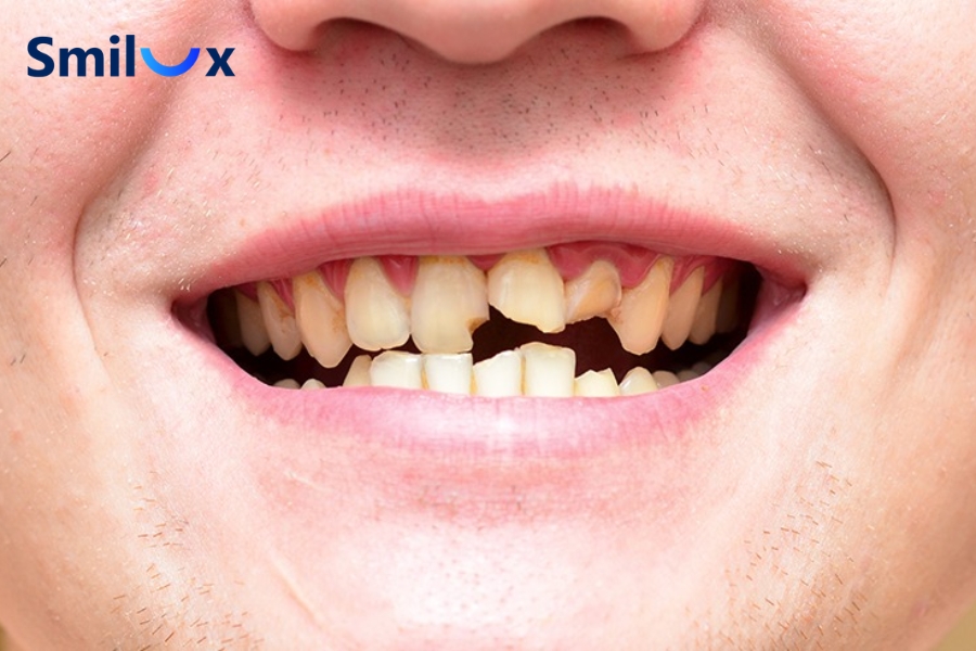 17 tuổi có thể cân nhắc bọc sứ khi răng sứt mẻ, gãy vỡ