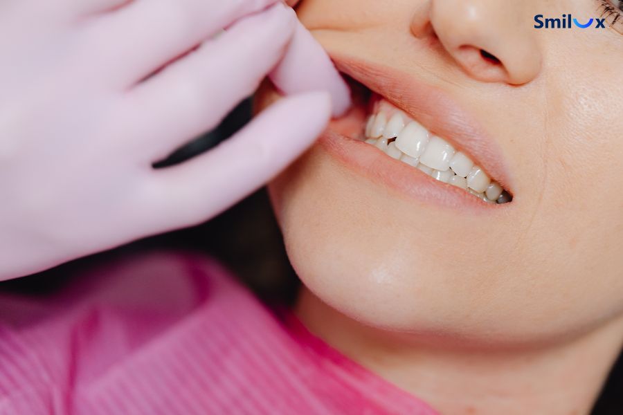 Viên lợi khi làm cầu răng sứ do tay nghề bác sĩ kém