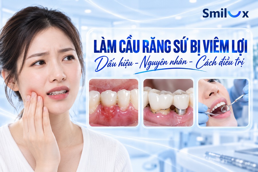 Làm cầu răng sứ bị viêm lợi: Nguyên nhân và cách giải quyết triệt để