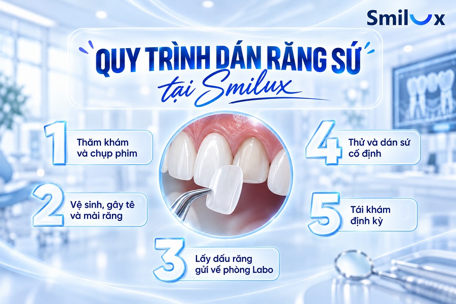 Quy trình dán răng sứ Veneer chuẩn Y Khoa tại Smilux