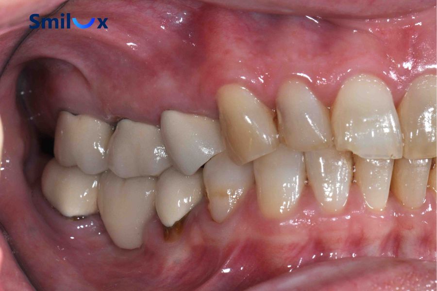 Sâu răng ở răng trụ có thể gây đau nhức kéo dài sau khi làm cầu răng sứ