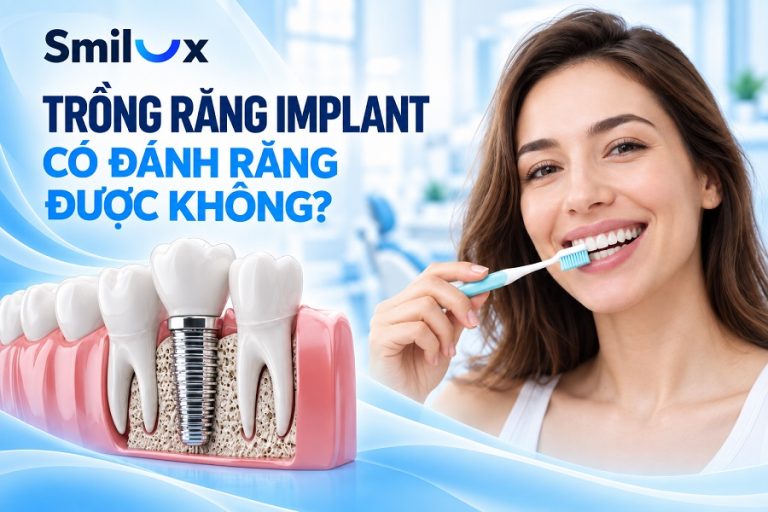Trồng răng Implant có đánh răng được không? Bác sĩ Smilux giải đáp