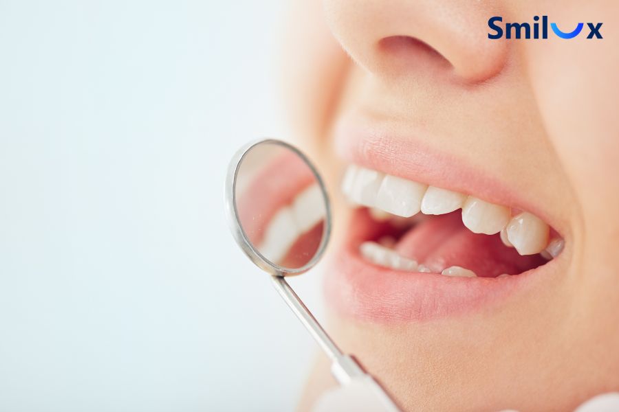 Răng lệch nhẹ, khấp khểnh nhẹ có thể dán sứ veneer