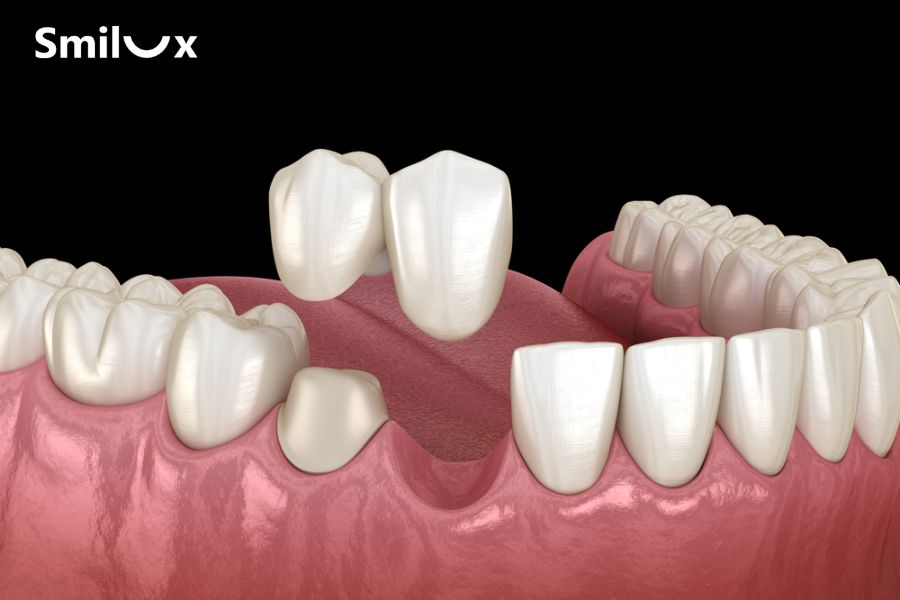 Thời gian phục hình nhanh thường chỉ mất khoảng 2 - 3 ngày