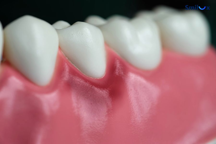 Sưng đỏ vùng nướu là một trong những dấu hiệu dễ nhận biết khi bị viêm lợi