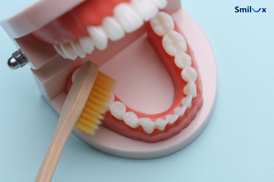 Viêm nướu do vệ sinh không đúng cách sau khi làm cầu răng sứ