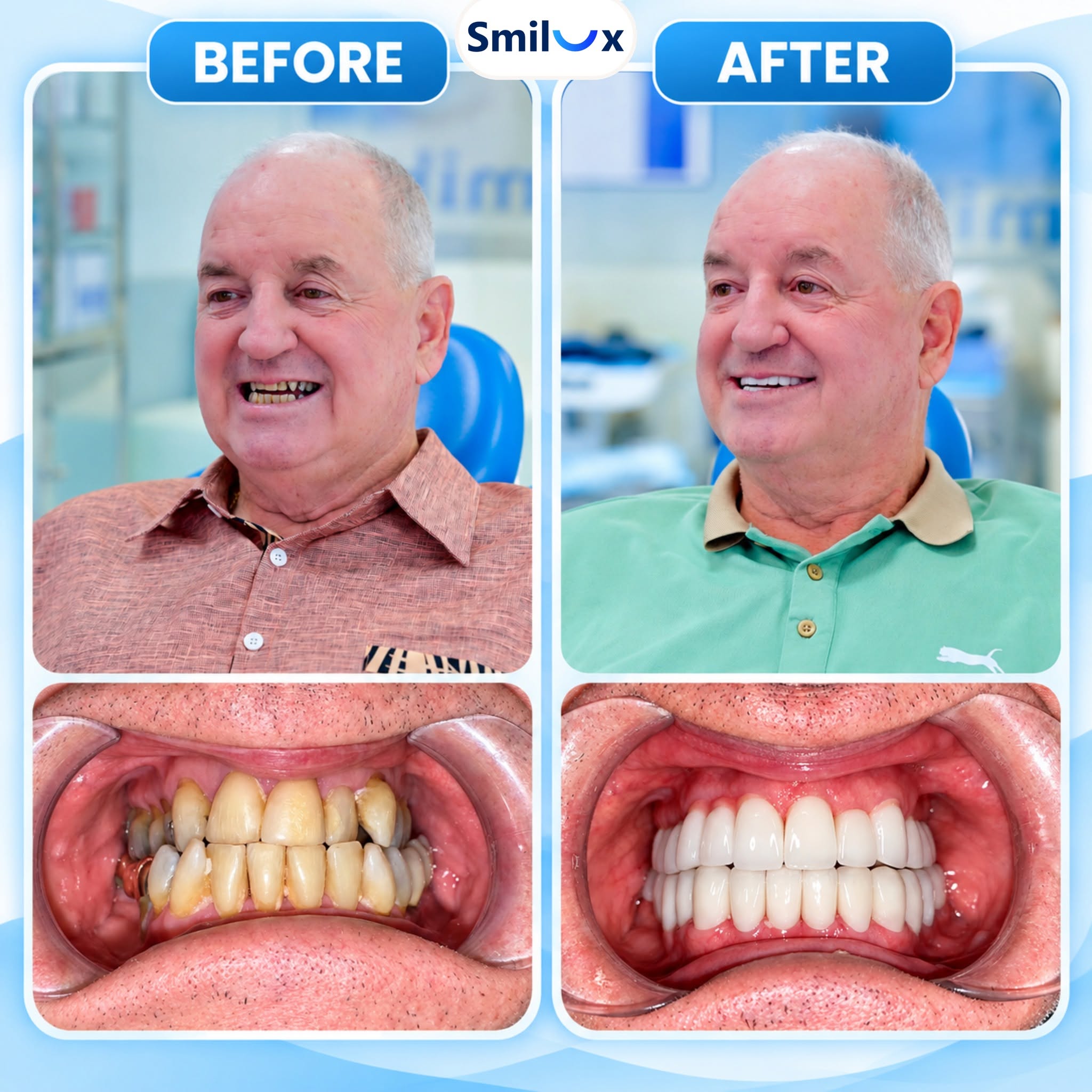 Hình ảnh khách hàng trước và sau khi làm răng sứ thẩm mỹ tại Smilux