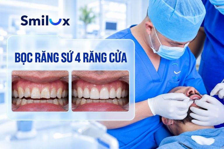 Bọc răng sứ 4 răng cửa giá bao nhiêu tiền? Giải đáp chi tiết