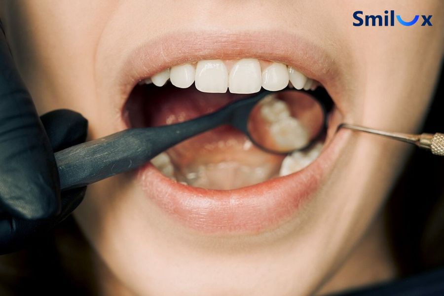 Răng sứ bị đen chân răng do tụt nướu