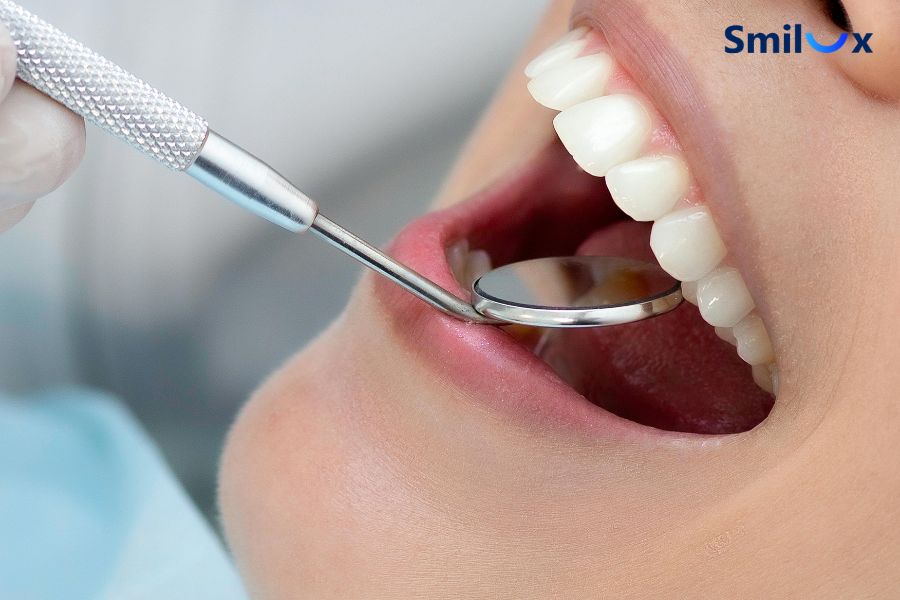 Bọc răng sứ giúp cải thiện thẩm mỹ với các răng cửa ố vàng