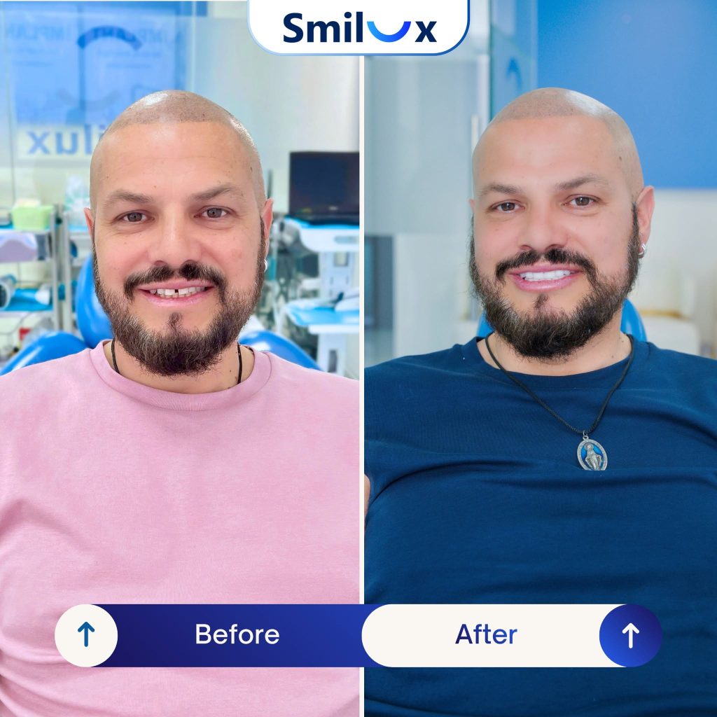 Hình ảnh khách hàng thực tế trước và sau khi bọc răng sứ tại Smilux