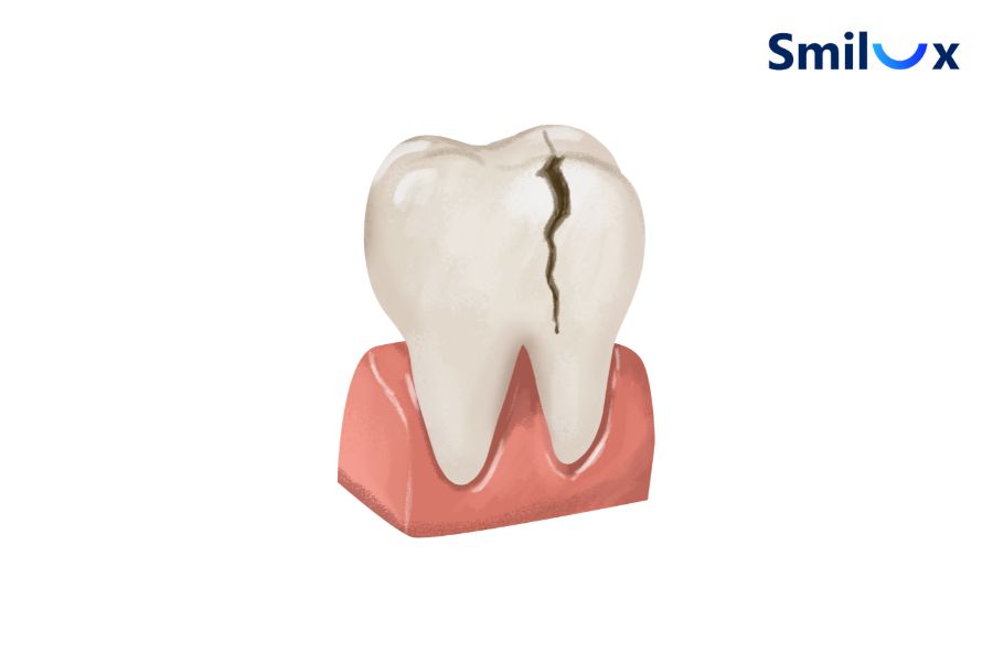 Cắn thực phẩm quá cứng có thể gây sứt, mẻ hoặc nứt vỡ mão sứ