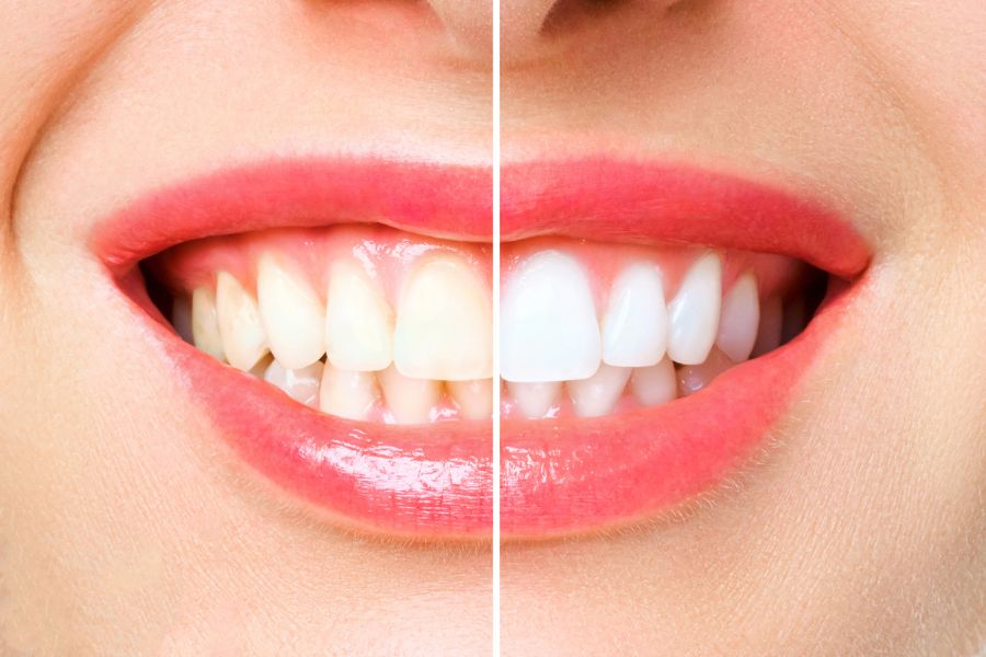 Tẩy trắng răng bằng chất tẩy trắng