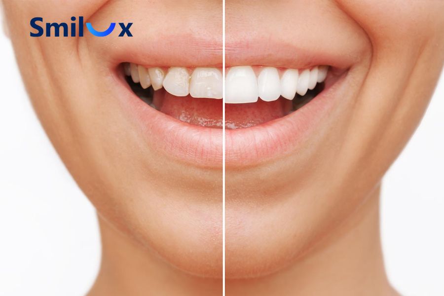 Nên cân nhắc thật kỹ trước khi quyết định bọc răng sứ 500k