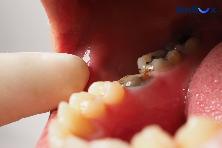 Dấu hiệu của tình trạng bọc sứ bị đen chân răng