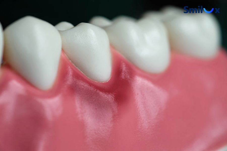 Nướu bị sưng đỏ là dấu hiệu cho thấy răng bị viêm tuỷ