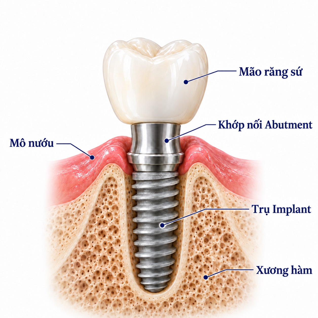 hình cấu tạo implant