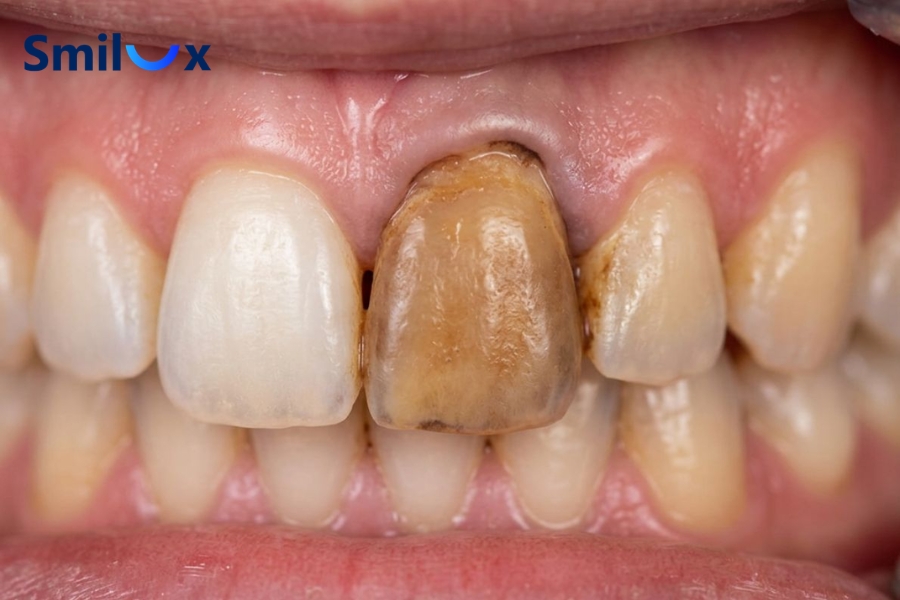 Răng sứ đổi màu sau thời gian sử dụng do mảng bám, sắc tố tích tụ
