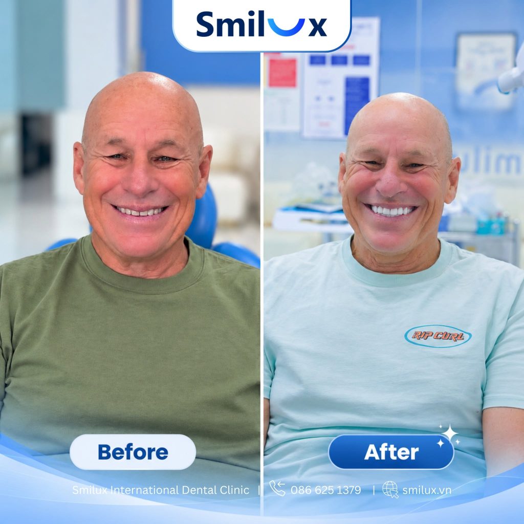 Hình ảnh khách hàng trước và sau khi điều trị tại Smilux