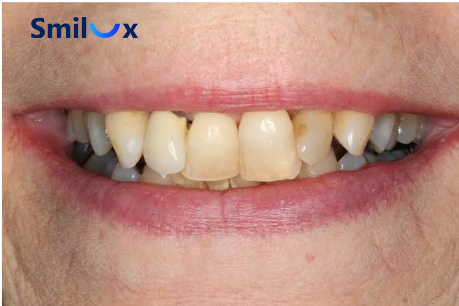 Hở chân răng, viêm tủy răng là các rủi ro phổ biến khi làm răng sứ giá rẻ 