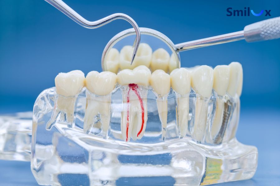 Viêm tuỷ sau khi bọc sứ xuất phát từ nhiều yếu tố khác nhau