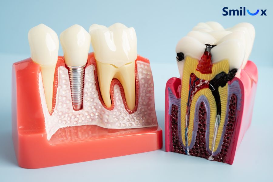Răng lấy tủy bọc sứ sau 10 năm không cần thay nếu vẫn đảm bảo chất lượng
