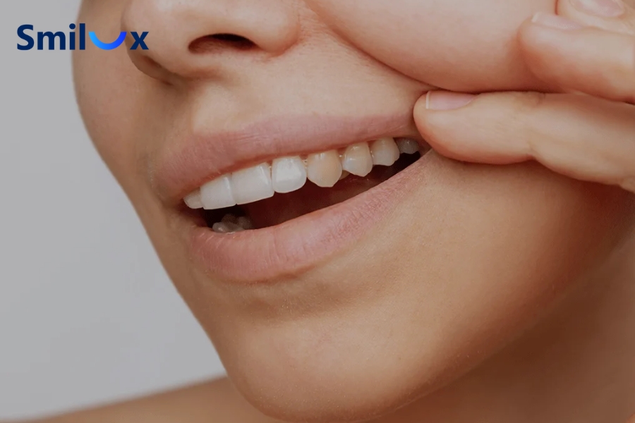 Răng sứ lệch màu chủ yếu ảnh hưởng đến thẩm mỹ
