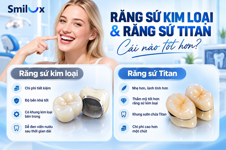 So sánh răng sứ kim loại và răng sứ Titan, loại nào tốt hơn?