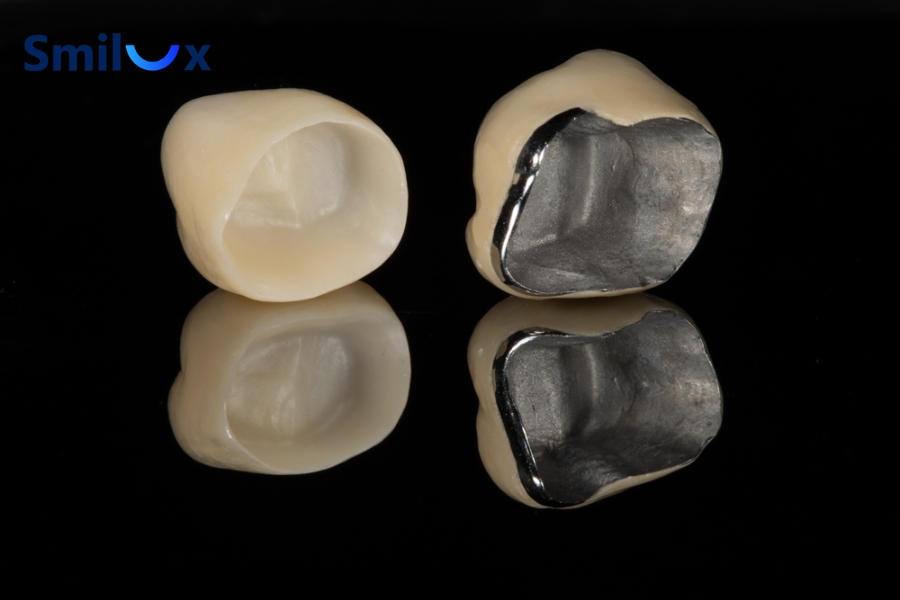 Khung sườn kim loại cản sáng và lớp sứ đục khiến răng sứ thiếu độ trong tự nhiên, dễ xuất hiện tình trạng lệch màu