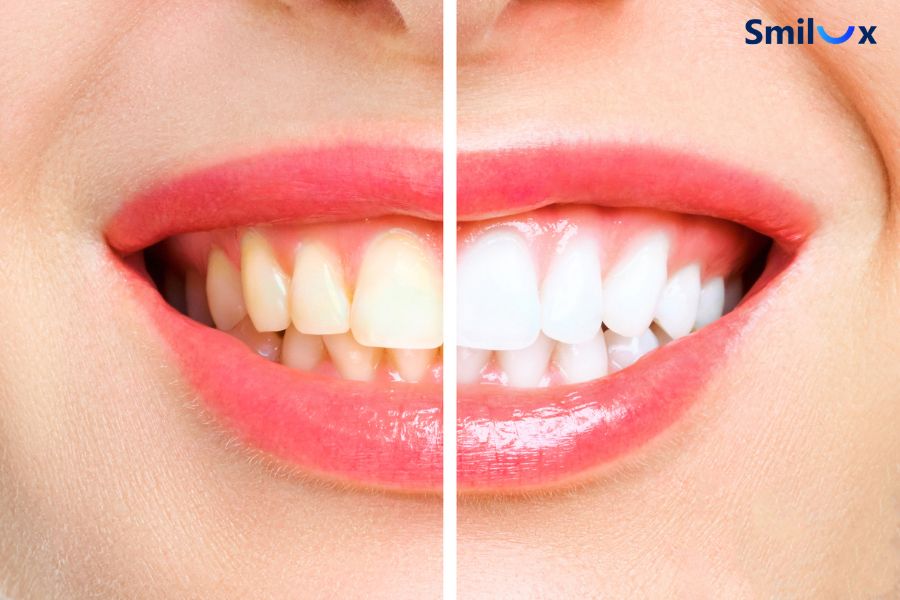 Tẩy trắng răng phù hợp với tình trạng răng ố vàng