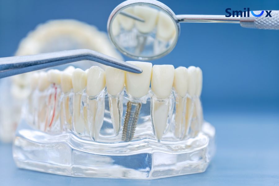 Nếu răng sứ bị mài mòn nghiêm trọng, bạn cần thay răng sứ mới