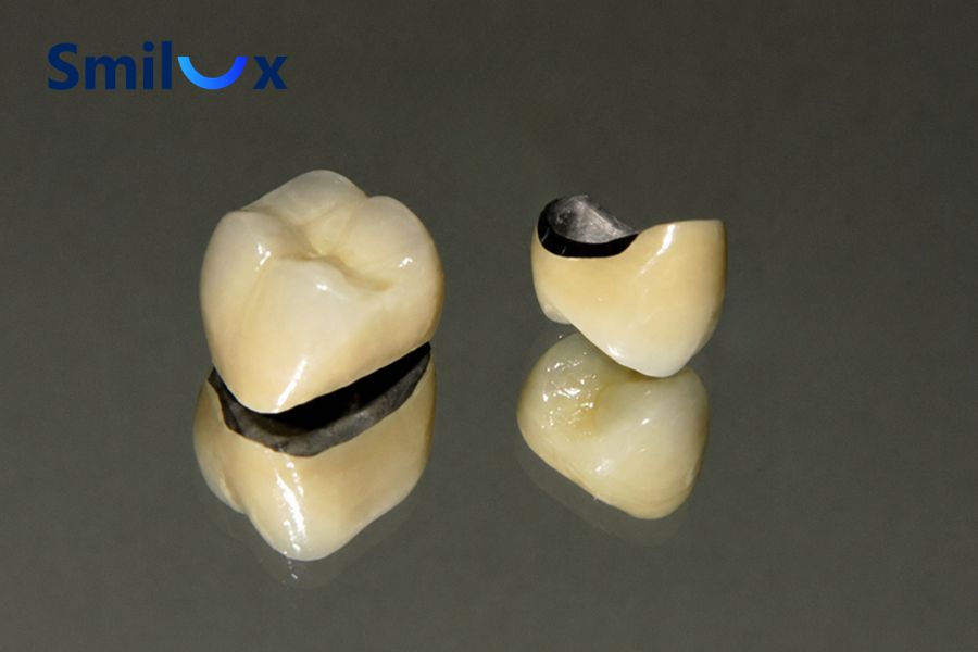 Răng sứ Titan có phần khung sườn chứa hợp kim Titan