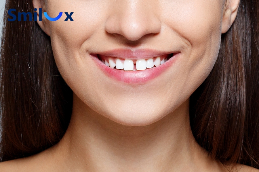 Những trường hợp nên cân nhắc bọc sứ 4 răng cửa.