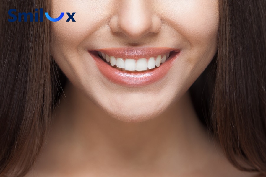 Bọc sứ răng cửa phù hợp với răng sâu lớn, mẻ vỡ nhiều hoặc nhiễm màu nặng