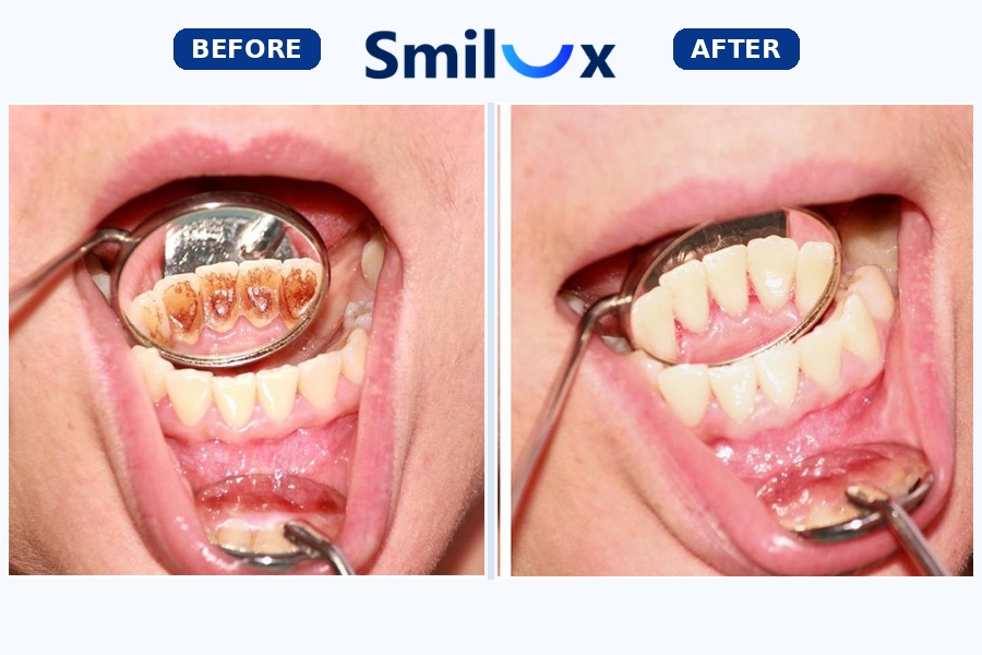 Ưu điểm của cạo vôi răng định kỳ tại Smilux Dental