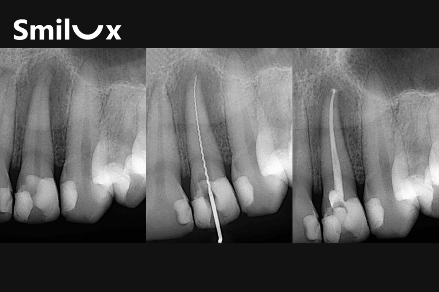 Chữa tủy răng sớm giúp giữ lại răng thật, còn nếu để lâu, nhiễm trùng lan rộng có thể khiến răng phải nhổ bỏ